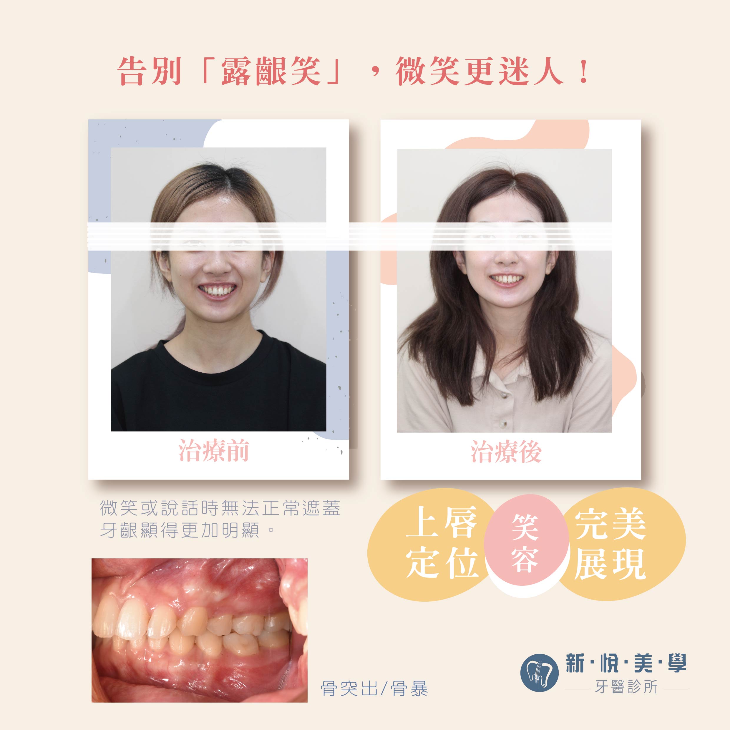 告別牙齦笑，還你微笑曲線的第2張圖片